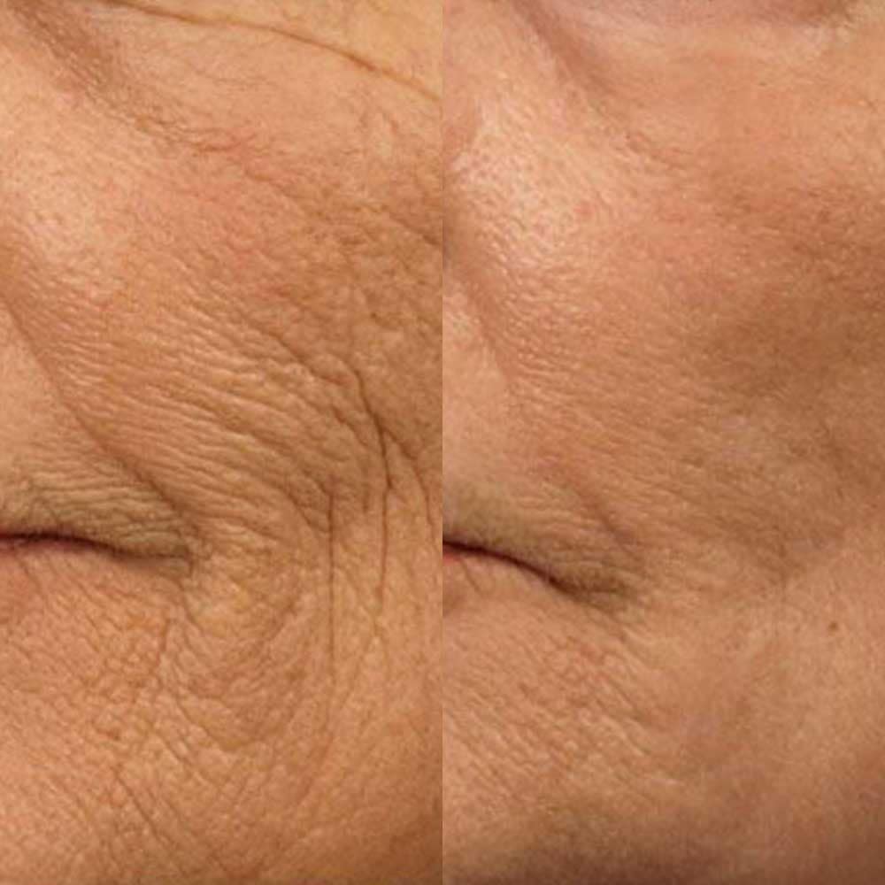 Profhilo® Skin Booster