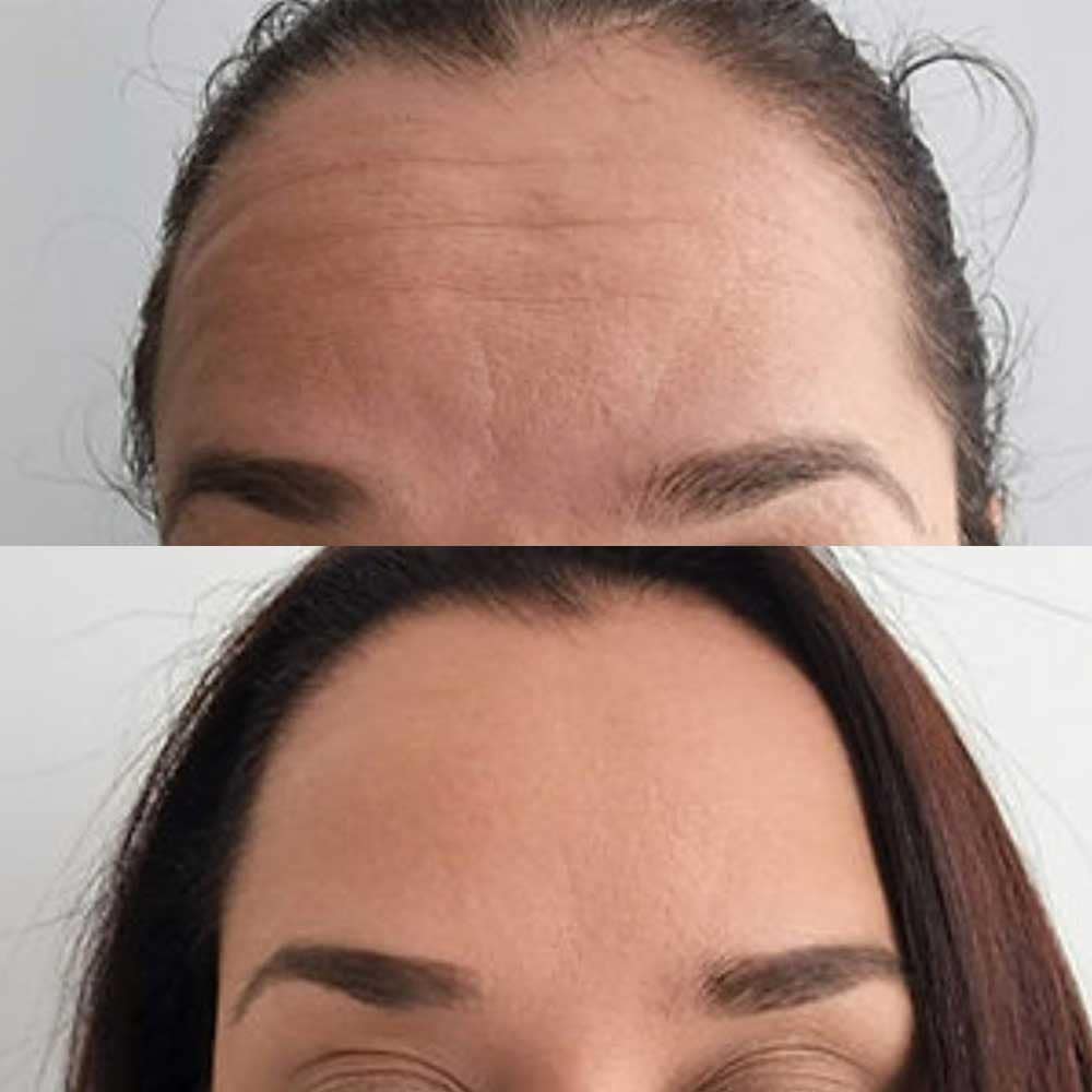 Tox for Forehead Lines