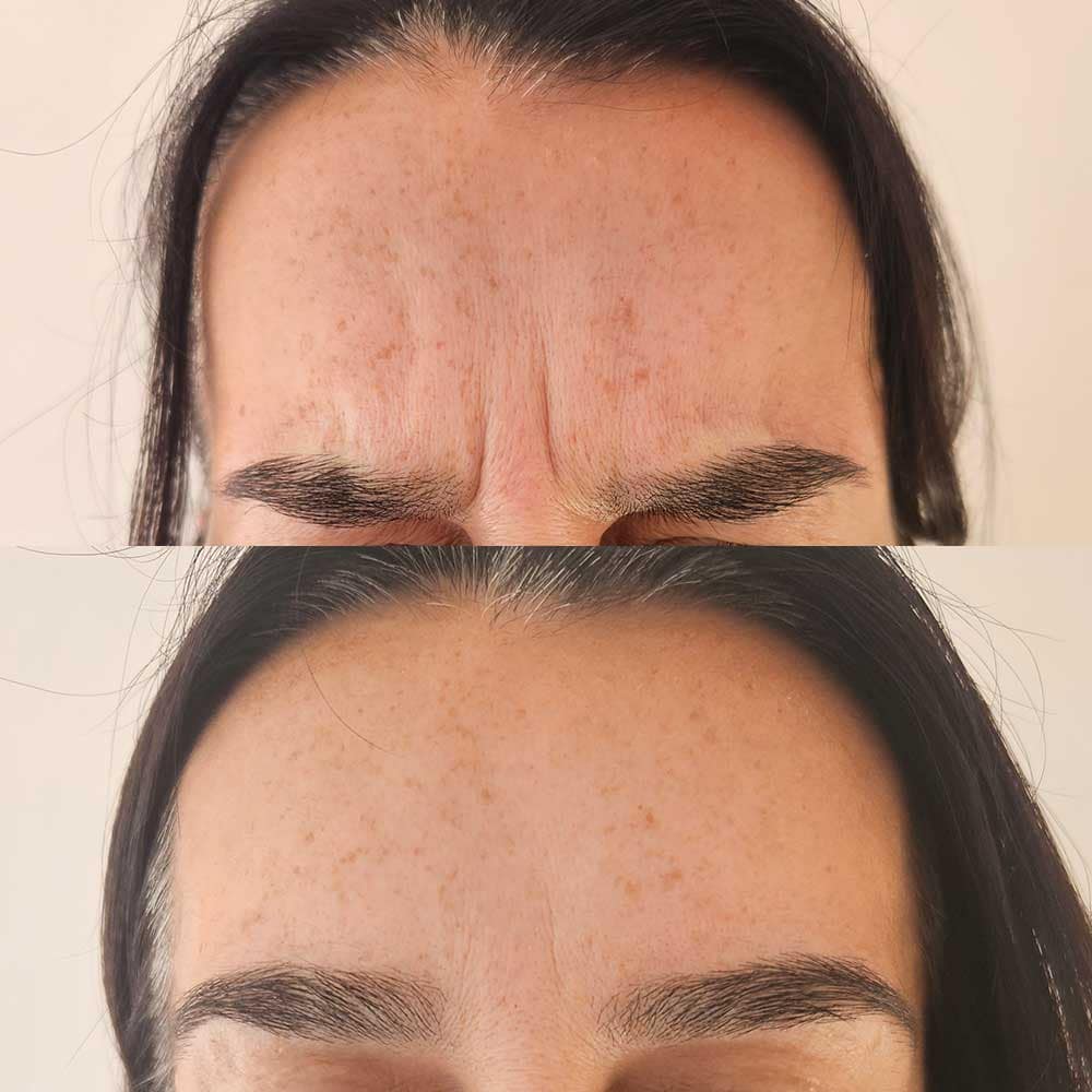 Tox for Frown 11 Lines