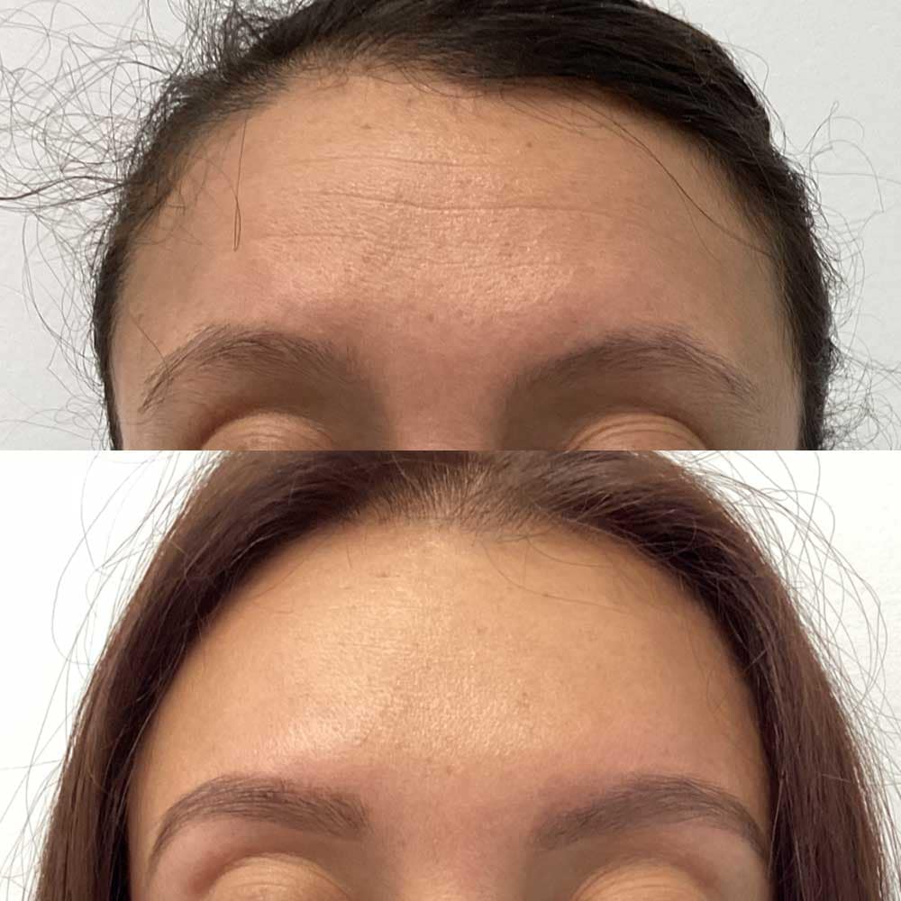 Tox for Forehead Lines
