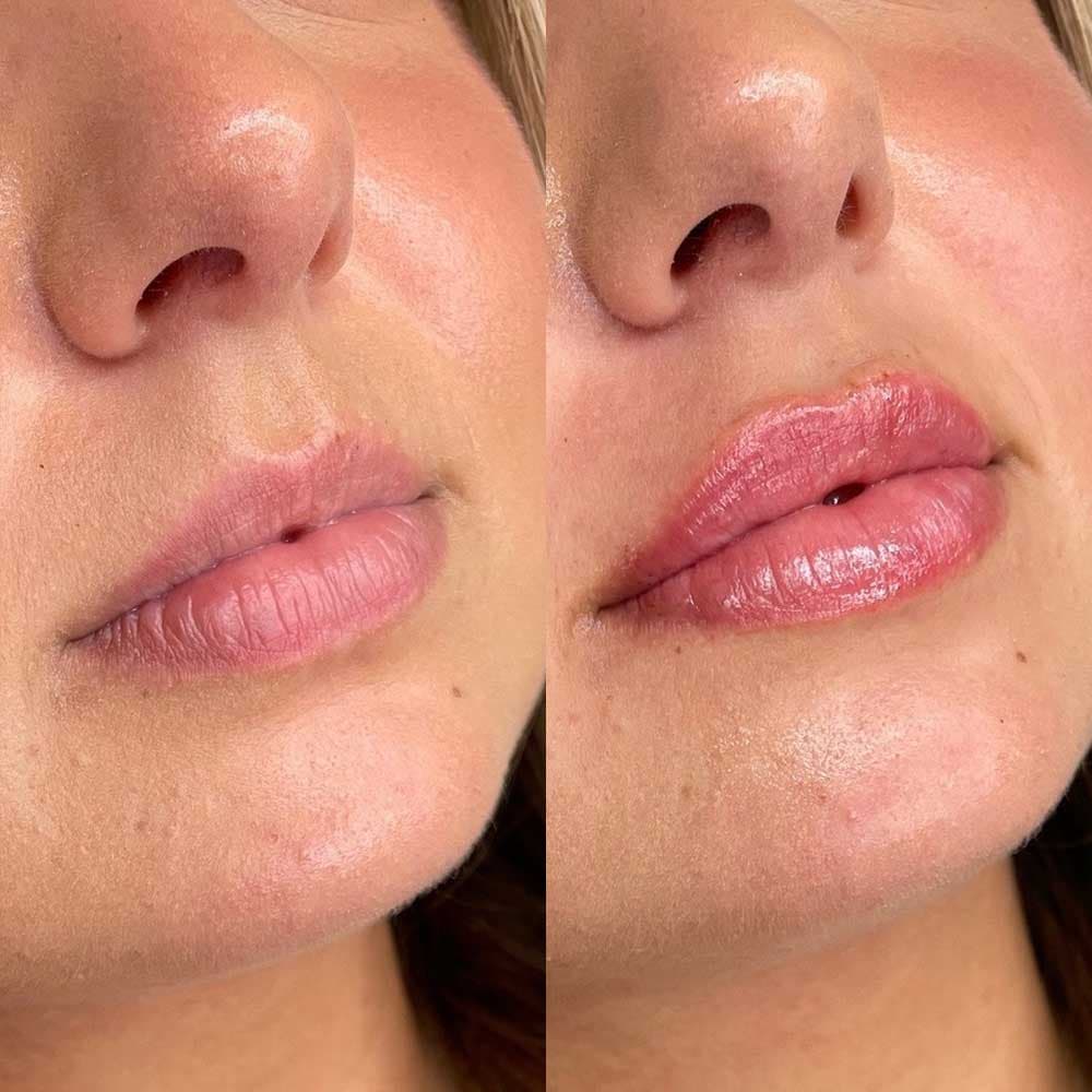Lip Filler