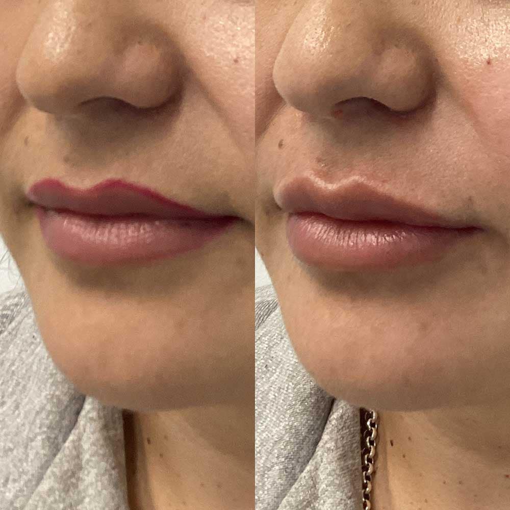 Lip Filler