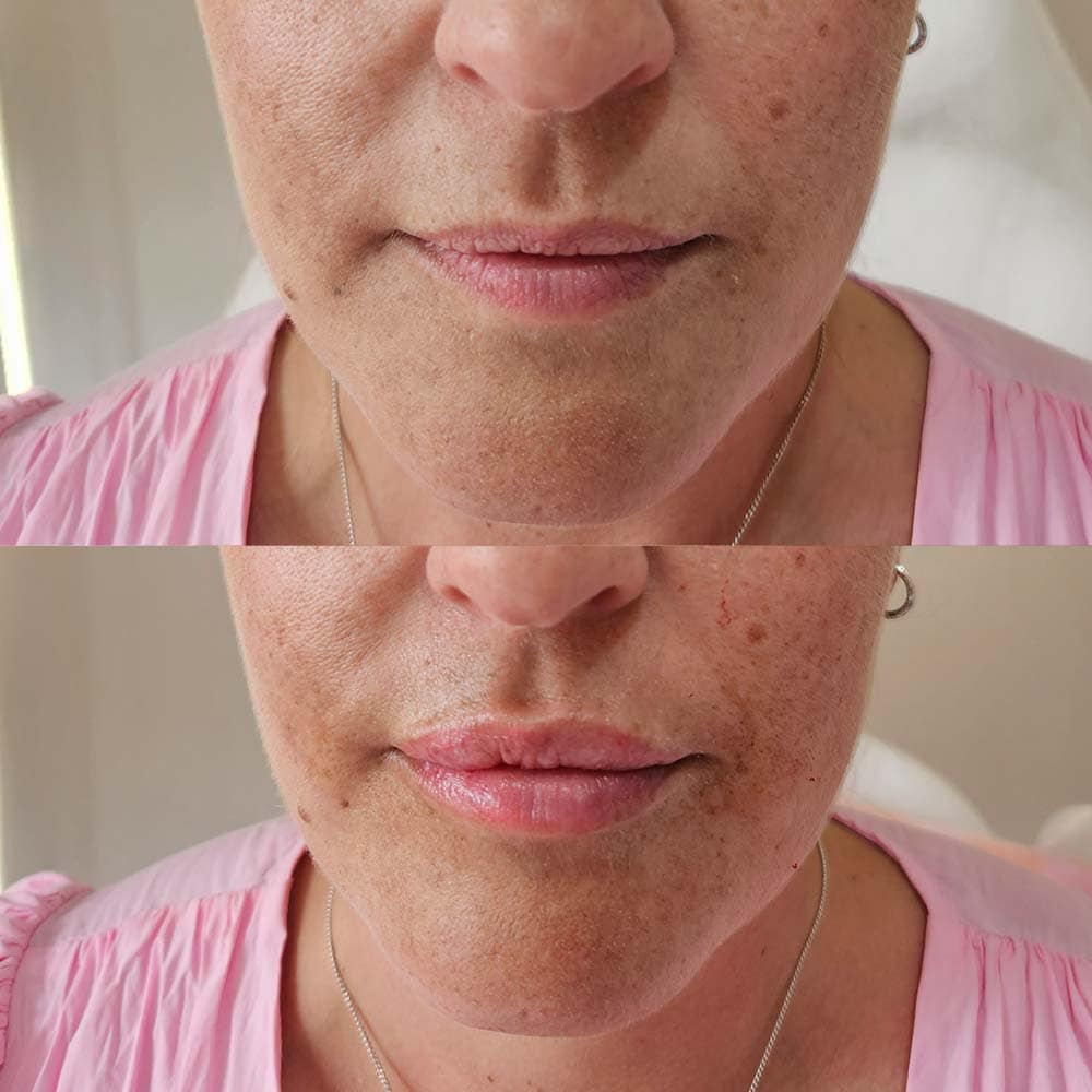 Lip Filler