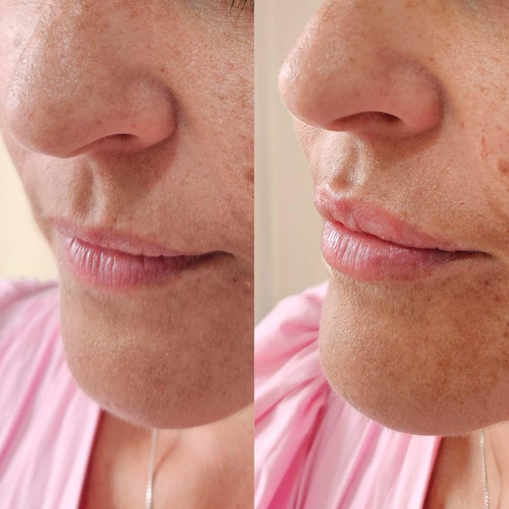 Lip Filler