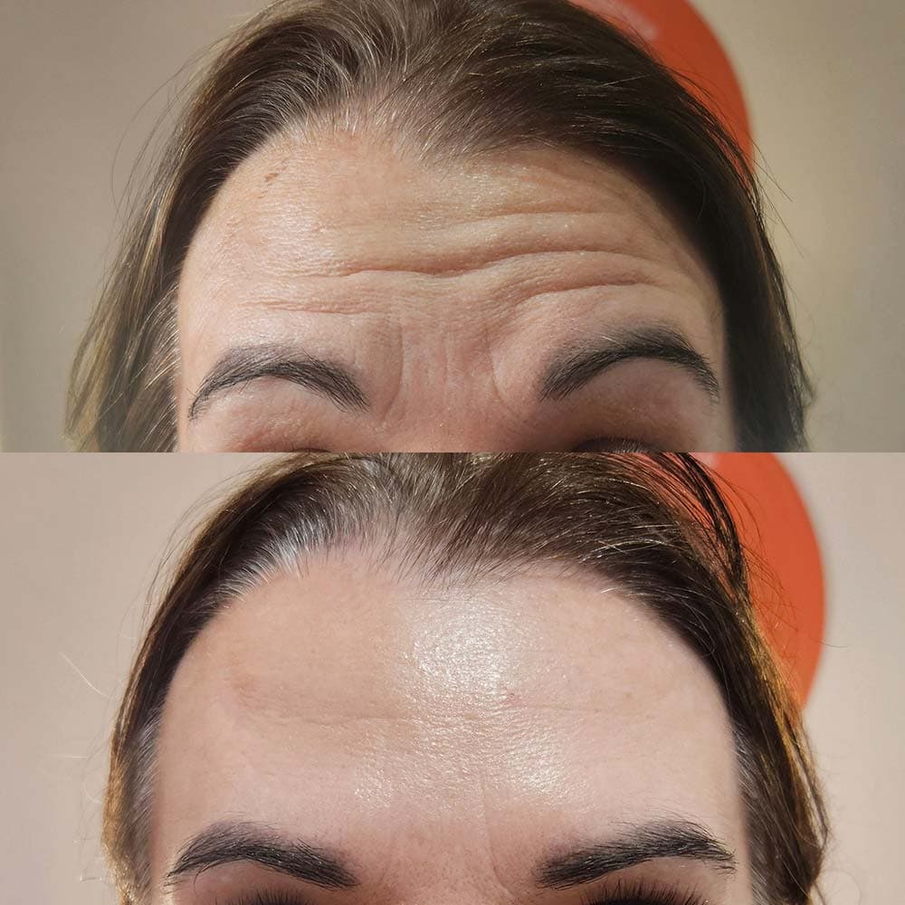 Tox for Forehead Lines