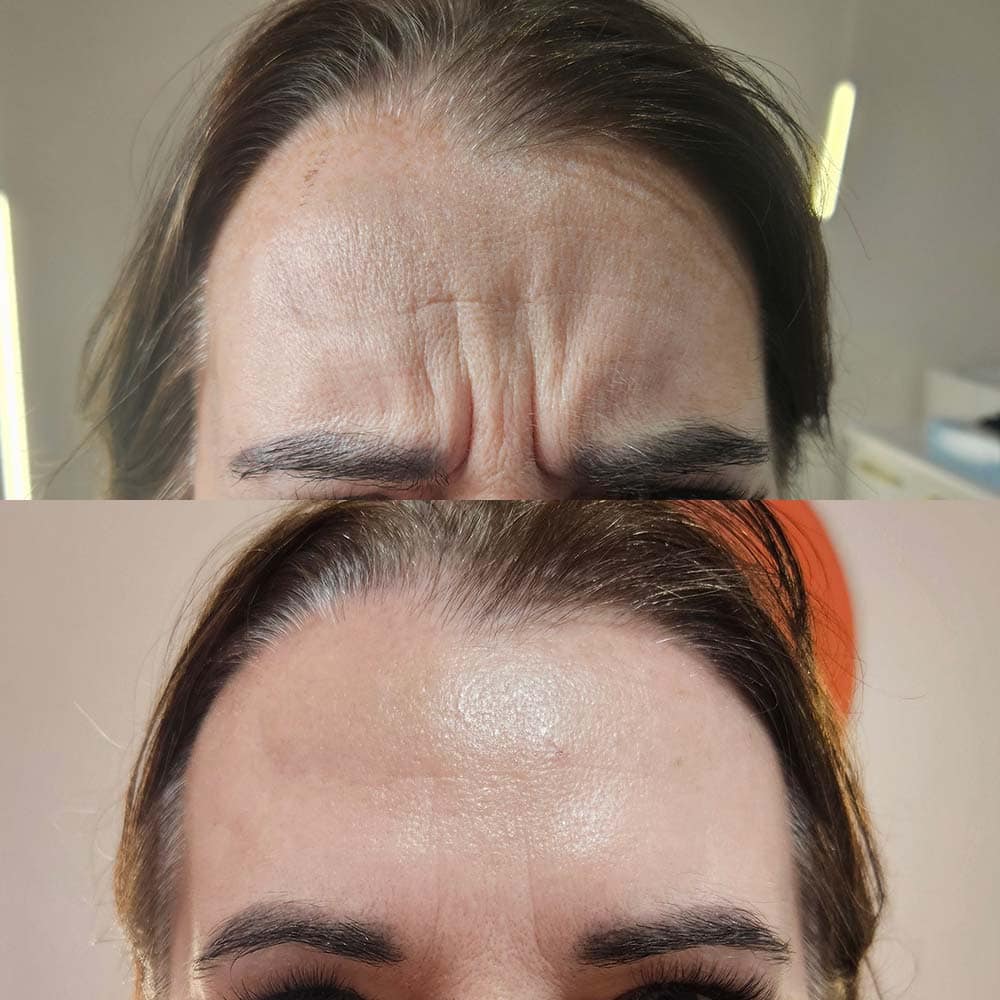 Tox for Frown 11 Lines