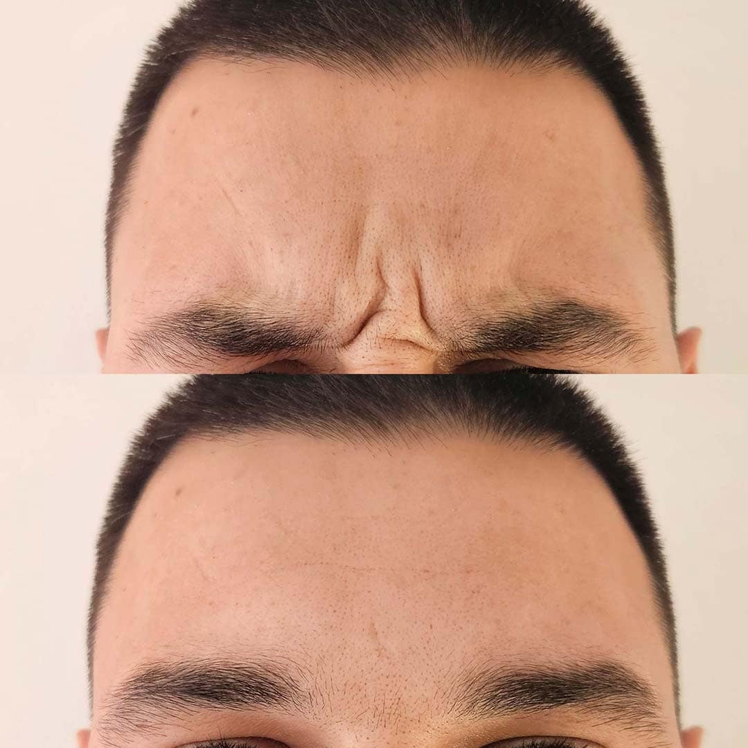 Tox for Frown 11 Lines