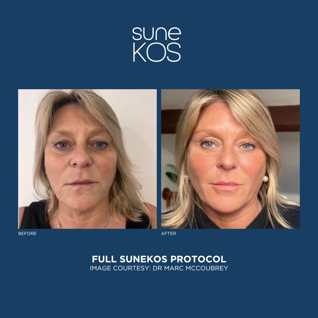 Full Sunekos Protocol