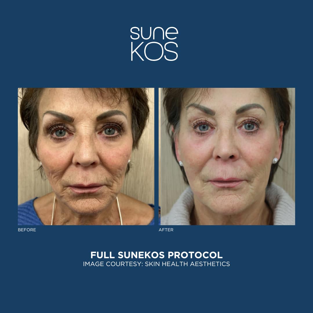 Full Sunekos Protocol