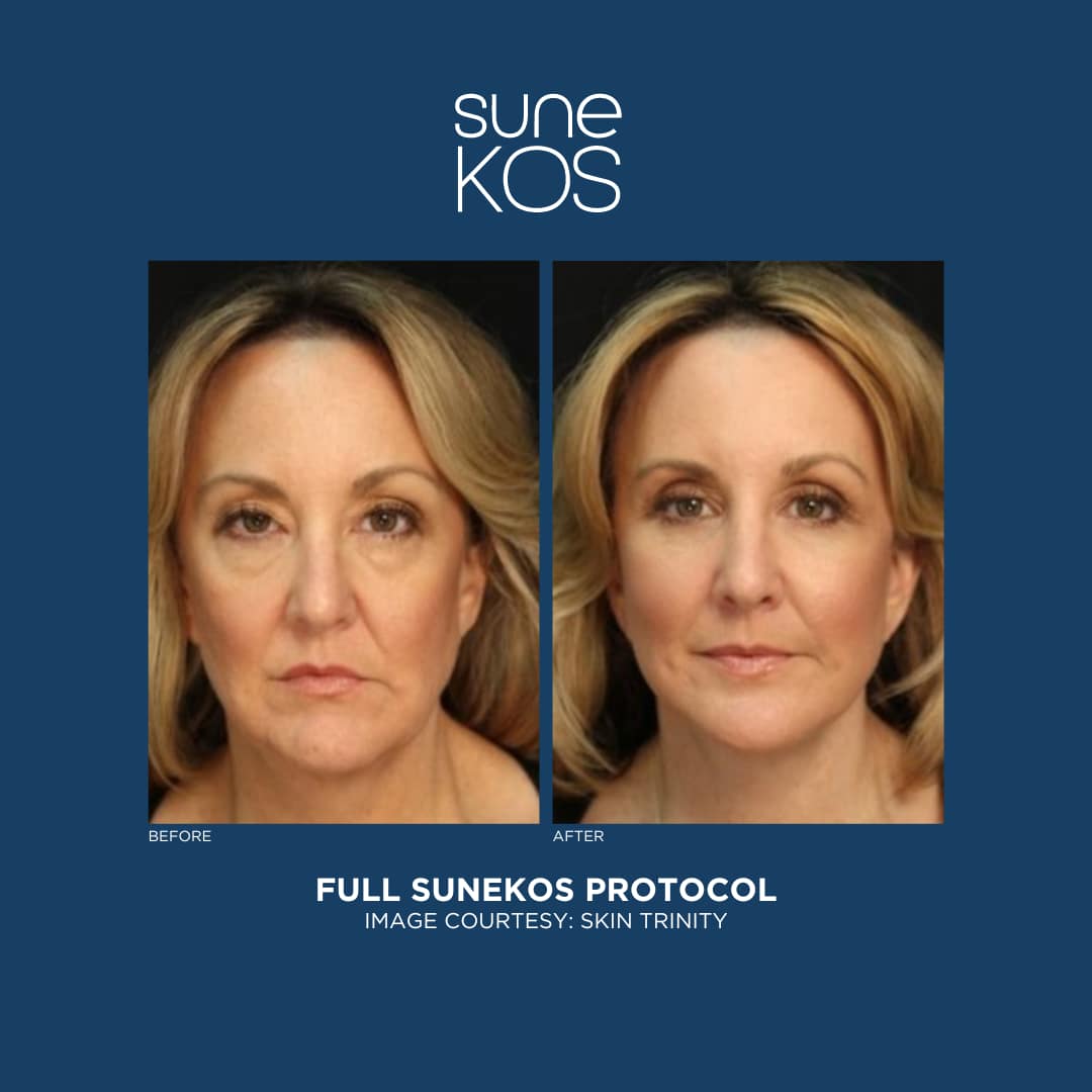 Full Sunekos Protocol