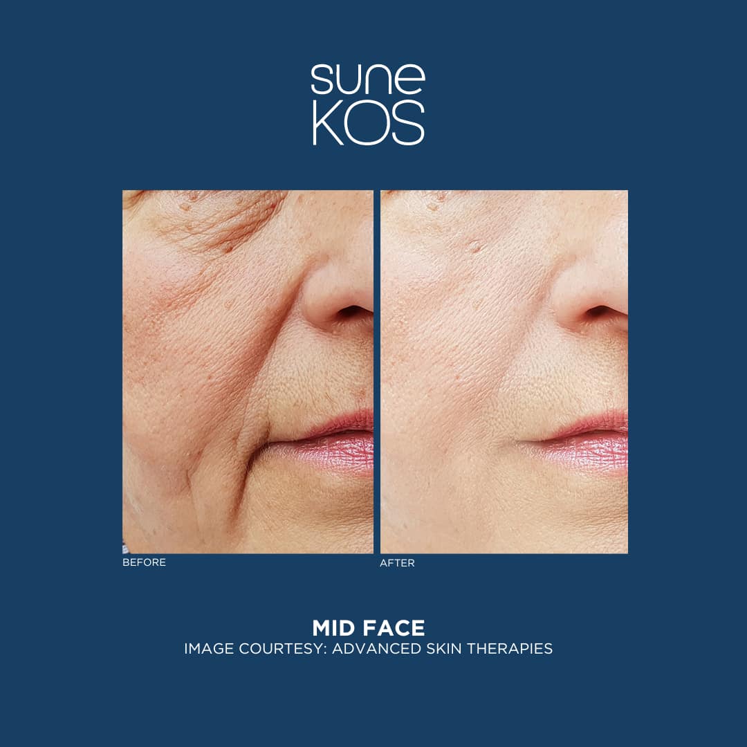 Sunekos Mid Face Treatment