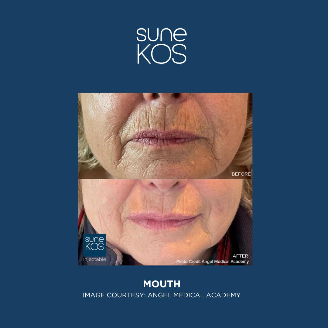 Sunekos Mouth Treatment