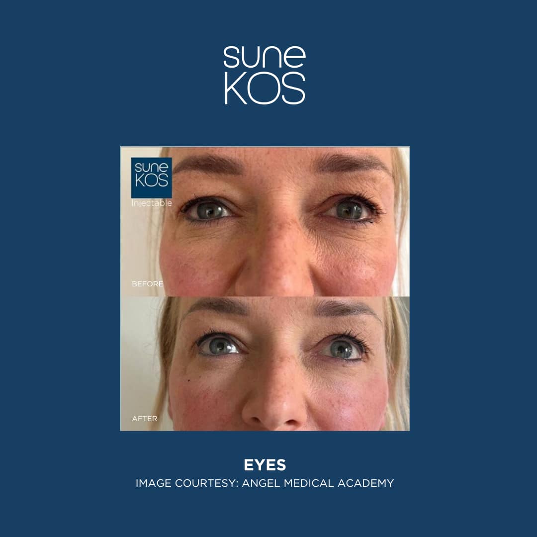 Sunekos Eye Treatment