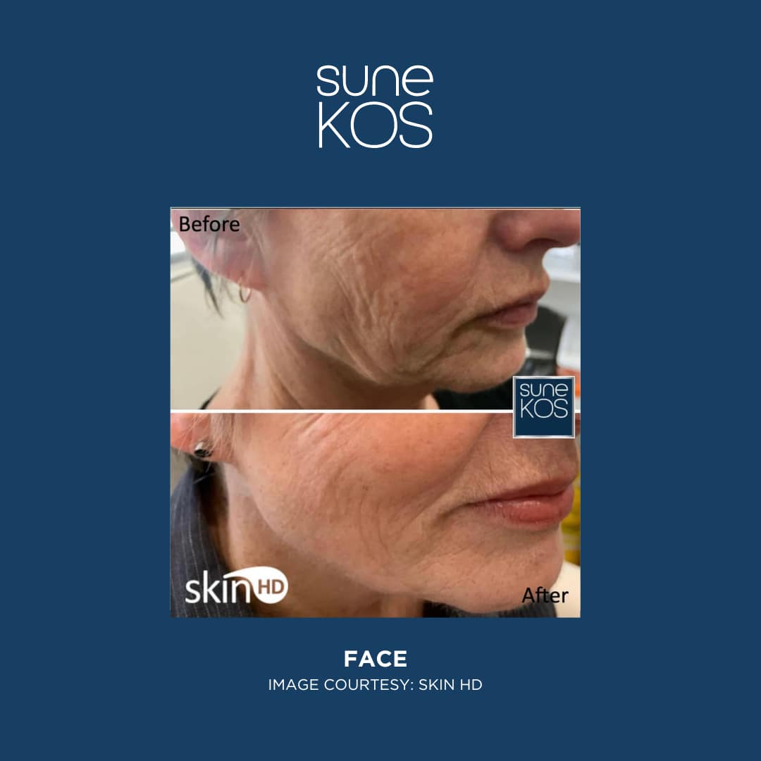 Sunekos Mid Face Treatment