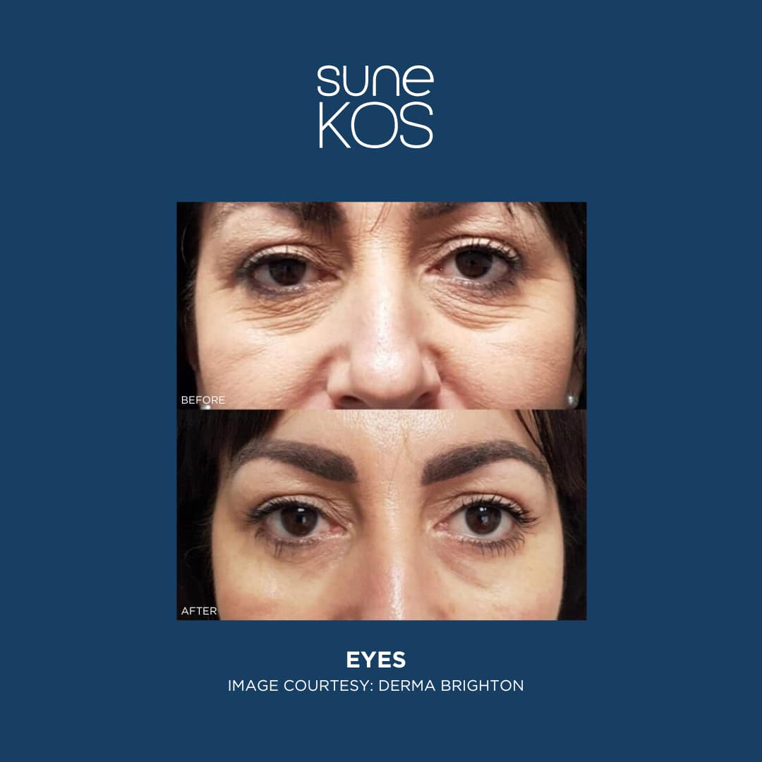 Sunekos Eye Treatment