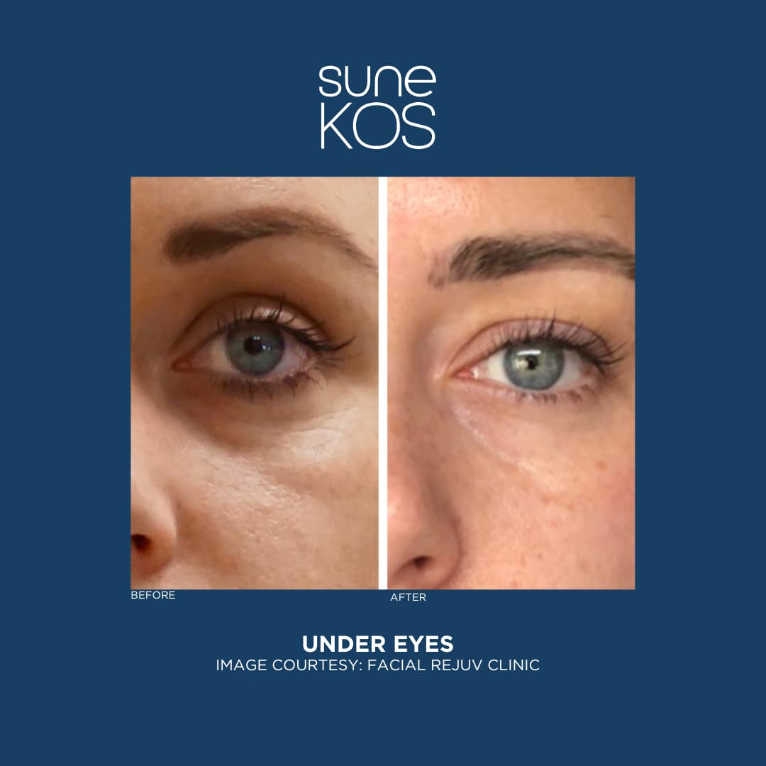 Sunekos Under Eye Treatment