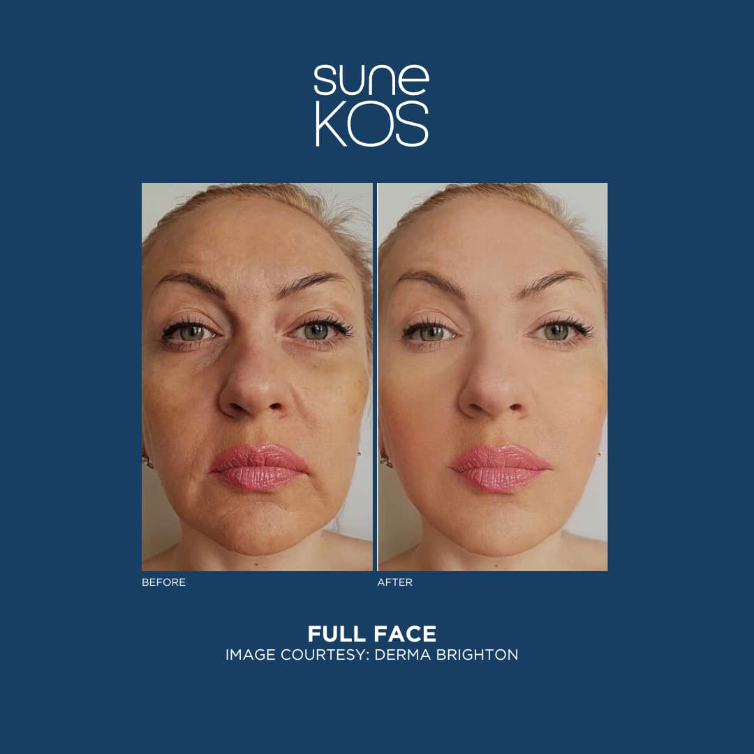 Full Sunekos Protocol