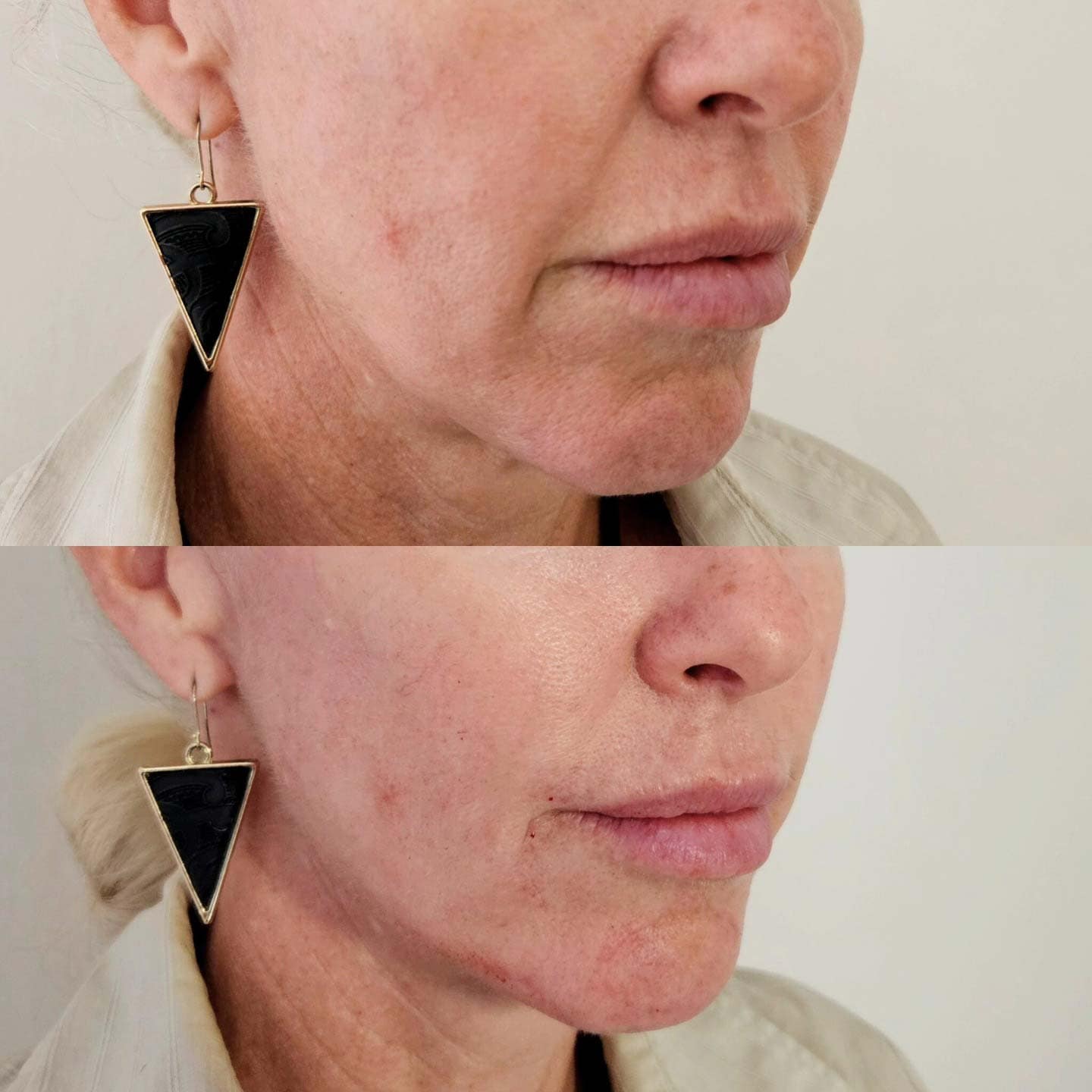 Lower Face Rejuvenation
